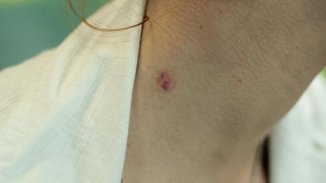 Удаление родинки — фото из отзыва «Мазью Стефалин эффективно удалять родинки» (1 из 3)