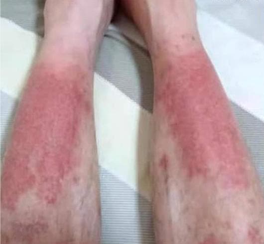 Крем от псориаза Dm Pharmalab Dermaclear — фото из отзыва «Эффективное средство от псориаза»
