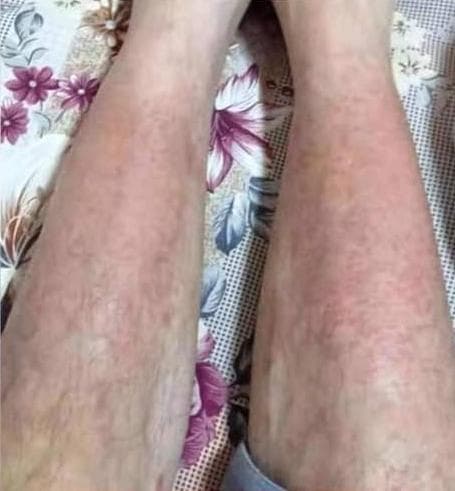 Крем от псориаза Dm Pharmalab Dermaclear — фото из отзыва «Эффективное средство от псориаза»