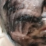 Alpika. Неинвазивная карбокситерапия фото 2 