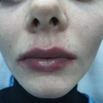 Увеличение губ гиалуроновой кислотой (Revanesse) фото 2 