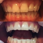 Косметическое отбеливание зубов White&Smile фото 1 