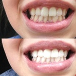Косметическое отбеливание зубов White&Smile фото 1 